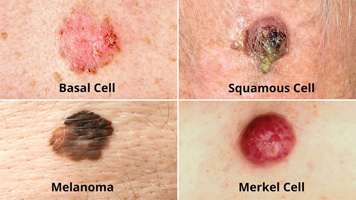 skin cancer